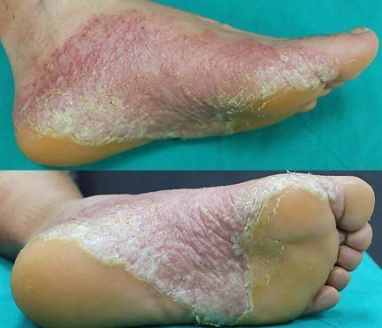 농포증이 나타난 환자의 발바닥 모습. 손발바닥 농포증은 홍반과 수포, 비늘, 각질이 함께 일어날 수 있다.&nbsp; &nbsp;건국대학교병원