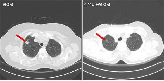 폐 결절(왼쪽)과 간유리 음영 결절(오른쪽). 은평성모병원 제공