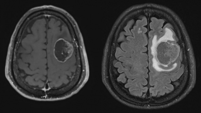 우측 편마비와 언어장애를 호소하는 환자에게 조영증감 MRI 검사를 시행한 결과 뇌전이암이 확인됐다. 전이암 주변으로 종양으로 의심되는 덩어리(왼쪽)와 부종이 관찰된다. 사진 제공=서울성모병원