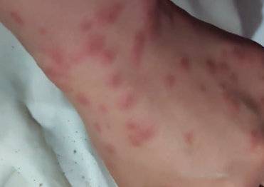 "몸에 두드러기가 올라왔다"며 A씨가 올린 사진 [사진출처=온라인 커뮤니티 보배드림 캡처]