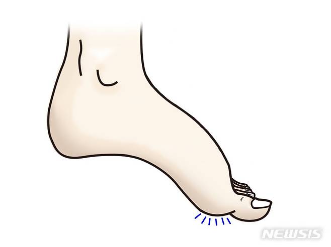 [서울=뉴시스]족부 첨족변형. (이미지= 한림대동탄성심병원 제공) 2023.04.12. photo@newsis.com.