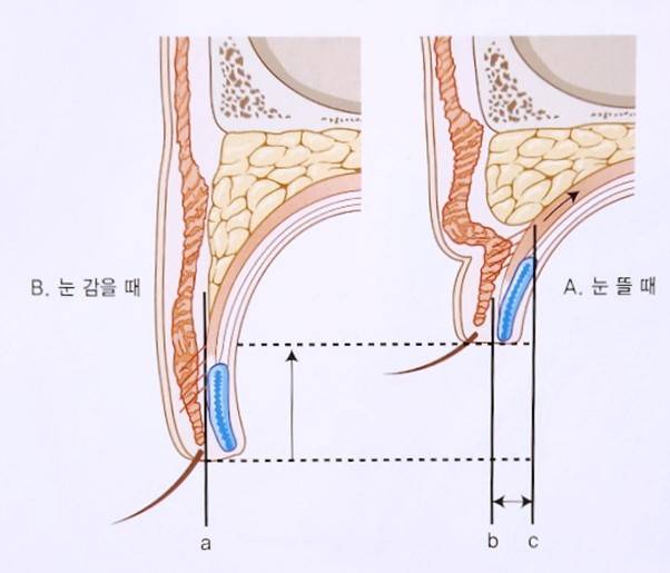 B 상태에서는 생기지 않던 쌍꺼풀이 A 상태에서는 자연스레 접혀서 드러난다. [출처 : 눈꺼풀 수술술기, 조인창, 군자출판사]