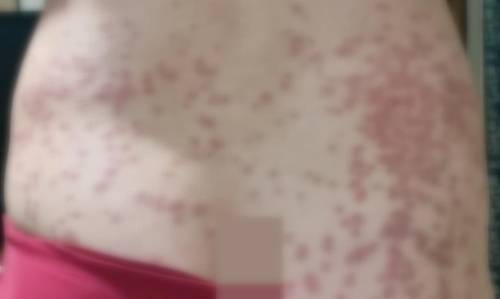 A씨가 병원 치료 후 지난 12일 촬영한 엉덩이 윗부분의 두드러기. A씨 제공. 연합뉴스