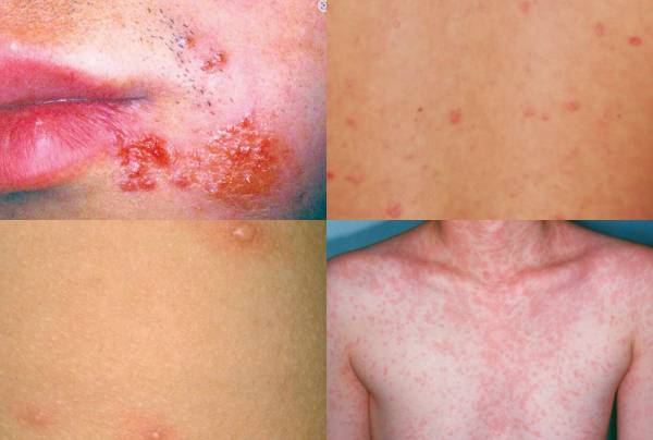 왼쪽 위부터 시계방향으로 단순포진, 2기 매독, 홍역, 수두. 서울대병원 제공