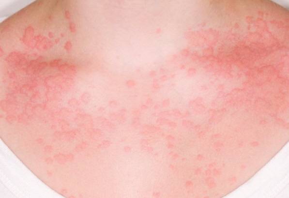 운동 후 몸에 발진이 생기고 가려움, 따가움 등이 동반된다면 콜린성 두드러기를 의심할 필요가 있다./사진=클립아트코리아