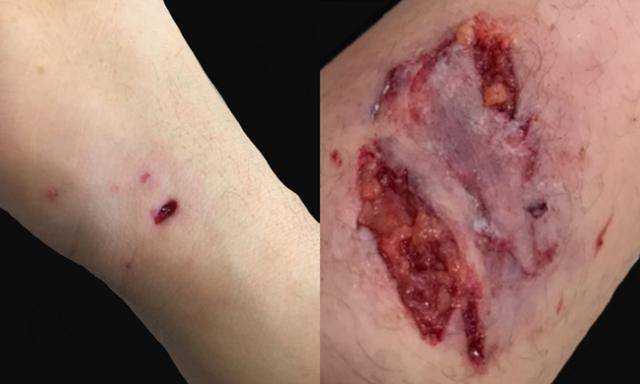 라쿤카페에서 사람이 라쿤에게 물린 상처. 가축화가 되지 않은 야생동물들은 사고의 위험성을 항상 안고 있다. 동물복지문제연구소 어웨어 제공