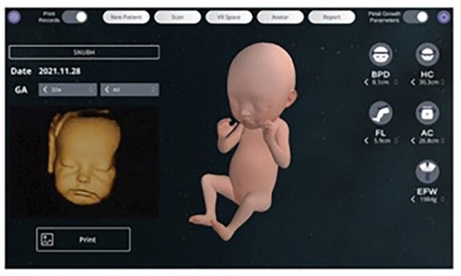초음파를 기반으로 가상현실에서 생성된 태아의 모습/사진=분당서울대병원