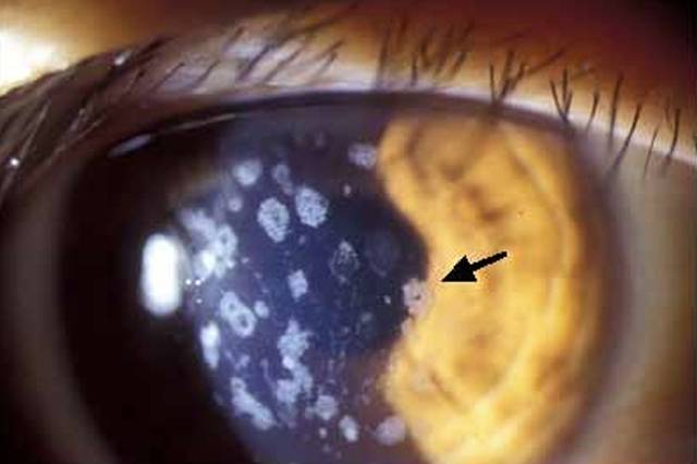 아벨리노 각막이상증으로 각막 혼탁 증상이 나타난 국내 환자의 모습. 사진제공=연세대학교 의대 각막이상증연구소
