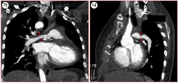 [사진3] 여전히 작은 좌우 폐동맥(화살표): 우폐동맥(가), 좌폐동맥(나)