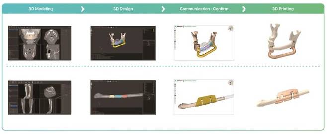 컴퓨터 시뮬레이션과 3D 프린팅 기술을 이용해 하악 재건술 가이던스를 제작하는 과정. [자료=강북삼성병원]