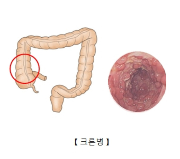 최근 높은 인기를 얻고 있는 드라마 '닥터 차정숙'에서 언급된 크론병을 향한 관심이 높다. 발병 원인은 정확히 파악되지 않았지만 지속적인 약물 치료가 필요하다. /사진=서울아산병원