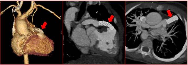 [사진 2-2] 우심실과 폐동맥을 연결한 도관과 스텐트(화살표).