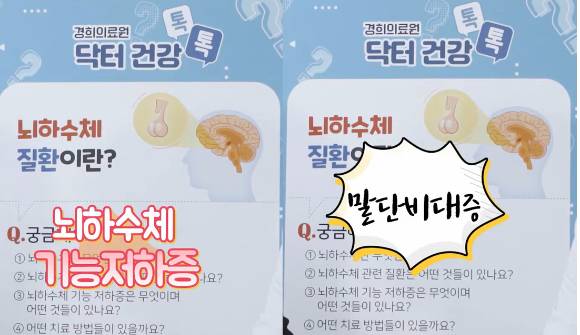 뇌하수체 호르몬 불균형으로 생기는 질환으로는 말단비대증, 뇌하수체 기능저하증 등이 있다. [사진=경희의료원]