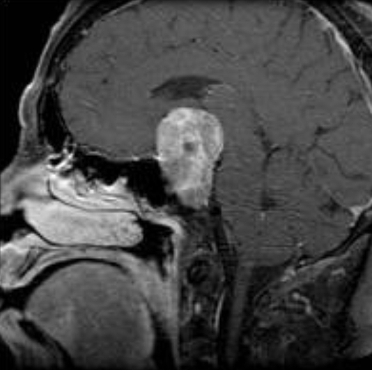 뇌하수체에 발생한 거대선종 모습. 사진제공=미국 존스홉킨스 의대