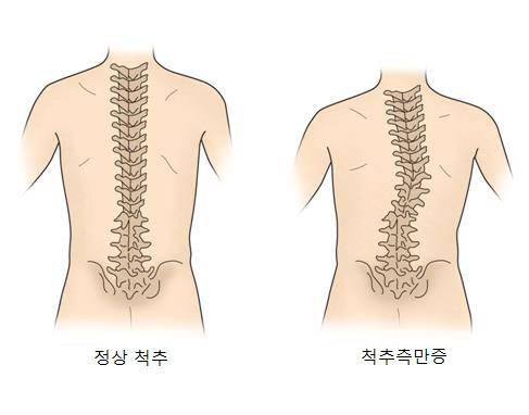 척추 측만증 [출처: 서울아산병원]