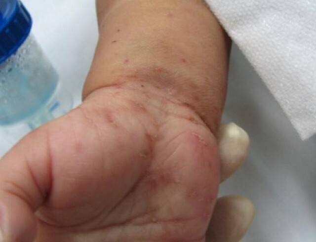 소아는 팔뚝과 손바닥, 손목 주름에 나타난 옴진드기 감염 모습. 카렌 맥코이(Karen McKoy)