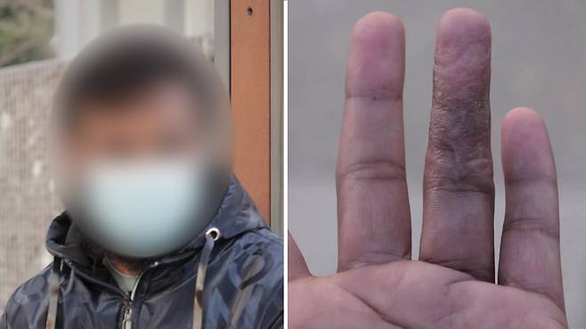 좌: 아드난 씨 / 우: 접합수술 후 손가락이 굽혀지지 않는다