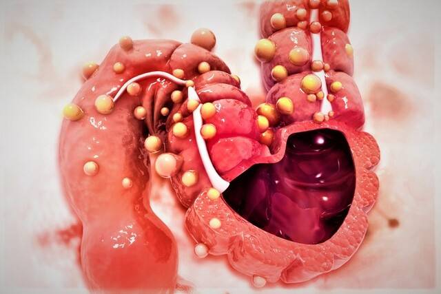 크론병과 궤양성 대장염은 장에 만성적인 염증이 생기는 난치성 희귀질환이다. 게티이미지뱅크