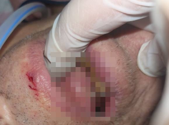 요양병원에 입원해있던 83세 환자의 입에서 구더기가 발견돼 딸 김모씨가 손으로 확인하고 있다. 제보자 김씨 제공