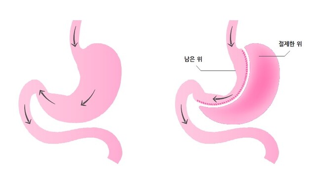 위소매절제술(Sleeve Gastrectomy) 수술방식. 서울아산병원