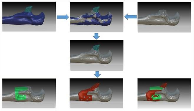 전남대병원 김명선 교수 연구팀과 (주)커스메디가 개발 중인 환자 맞춤형 3D 프린팅 금속 임플란트 치료 솔루션 모습. 해당 솔루션은 우선 정상 뼈(가장 위 왼쪽 푸른색 모델링)와 골절된 뼈(가장 위 오른쪽 회색 뼈)의 3D 모델링을 구성해 비교분석한다. 이에 따라 결손 부위를 대체할 수 있는 3D 프린팅 금속 부품(붉은색 모델링)의 가장 적합한 형태와 크기를 도출해 모델링한다. 초록색 모델링은 인공관절 부품이 정확하게 (뼈에) 안착되도록 미리 계획한 위치에서 골절된 부분이 정확하게 절제되도록 도와주는 가이드 부품. [자료=김명선 교수]