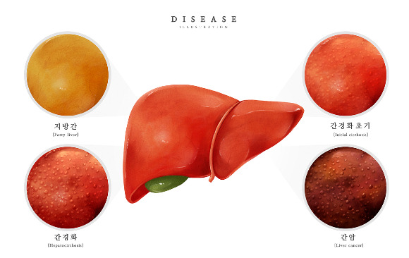 완치 개념이 없는 만성 질환인 간경변증은 예방과 조기진단이 가장 중요하다. 사진은 기사의 직접적인 내용과 관련이 없음. /사진=이미지투데이