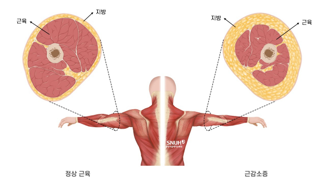 정상 근육(왼쪽)과 근감소증 근육. 사진 제공=분당서울대병원