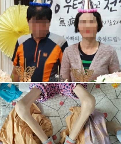 A씨의 건강할 때(위) 모습과 병원 시술 후 음식을 먹지 못해 뼈만 남은 상태(아래).  [A씨 아들 B씨 제공]