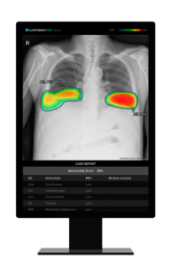 루닛 인사이트 CXR (사진=루닛)