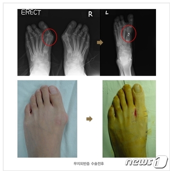 무지외반증 수술 전후 비교 모습(해운대부민병원 제공)