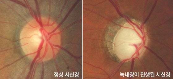 정상 시신경과 녹내장이 진행된 시신경. 중앙포토
