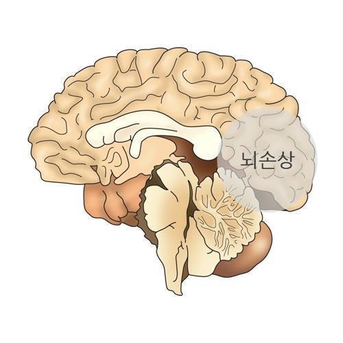 외상성 뇌 손상 [출처: 서울아산병원]