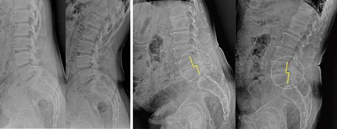 정상 요추(왼쪽)와 척추전방전위증 X-레이 사진. 사진제공=바른세상병원