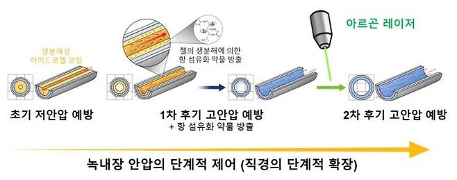 연구팀은 형상기억 고분자 소재를 이용한 방수 유출 튜브를 개발했다. 튜브 안에 코팅된 하이드로젤은 초기에 안압이 과하게 떨어지는 초기 저안압과 안구 표면의 섬유화를 막는다. 또 아르곤 레이저로 환자의 안압 상태에 따라 튜브 직경을 조절할 수 있다. [자료=세브란스병원]