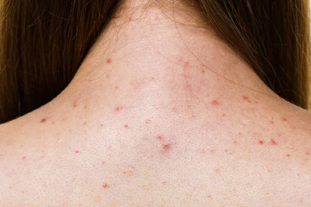 등과 가슴에 나는 여드름을 예방하려면 꼼꼼히 씻어내는 샤워 습관과 외부 자극을 줄이는 게 중요하다./사진=게티이미지뱅크