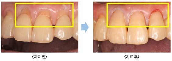 앞니에 발생한 치경부마모증​./사진=관악서울대치과병원 제공