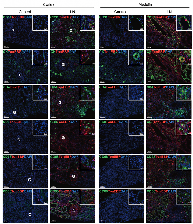 루푸스 신염 환자 신장조직 내 세포에서의 톤이비피 발현 모습.