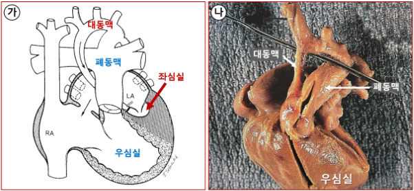 [사진1] 좌심 형성부전 증후군.(가) 모식도: 매우 작은 좌심실. (나) 부검 표본: 매우 작은 상행 대동맥.