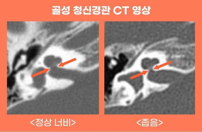 골성 청신경관 CT 영상