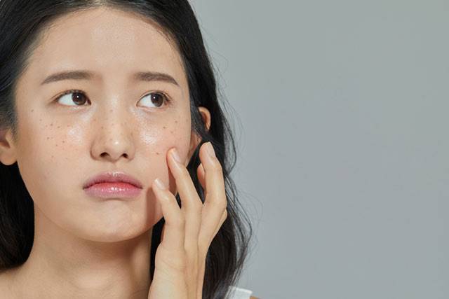 여름 자외선이 색소질환 재발률을 특별히 더 높이진 않는다. 색소치료는 자신이 여유가 있을 때 하면 된다. /게티이미지뱅크