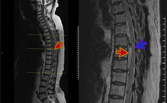 경막외 혈종 MRI 이미지 예시. 기사와 직접적 관련 없음. 붉은 화살표가 출혈로 인해 피가 찬 곳이고, 푸른색 화살표가 신경이 눌리면서 부은 부분이다. 사진 ['Acute Spinal Extradural Hematoma and Cord Compression: Case Report and a Literature Review', Cureus 2020 Nov]