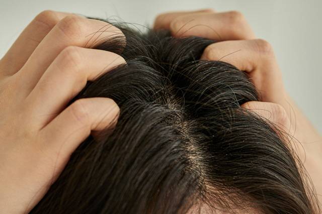 기름진 머리가 고민이라면 머리를 감을 때 레몬즙과 녹차가루를 사용하는 게 도움된다/사진=게티이미지뱅크