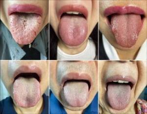구강작열감 증후군을 호소하는 환자들의 설진 모습. 한동하한의원 제공