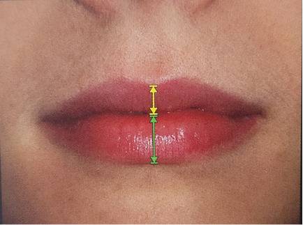 아랫입술은 윗입술에 비해 1.5~1.8배 정도 더 두껍다 (Facial aesthetics concepts and clinical diagnosis)
