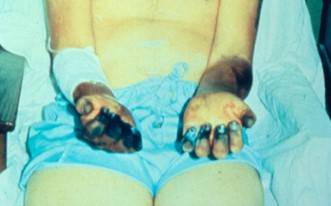 독일어로 페스트(pest), 영어로는 플레이그(plague)인 이 감염병은 혈관 내 응고증으로 피부가 검게 변해 '흑사병'으로 불린다. [사진=위키피디아]