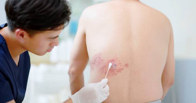 대상포진은 발열, 근육통 등 초기 증상이 감기와 유사하지만, 몸의 특정 부위에 국한된 붉은 발진과 통증으로 구별할 수 있다. [사진=게티이미지뱅크]