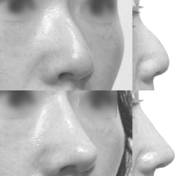 요즘 대세라는 '자연스럽고 화려한' 이 정도로 높은 코 역시 대부분 늑연골이 필요하지 않습니다. 한국인의 코가 20년 전과 달라지지는 않았으니까요. [사진=박준규 원장]