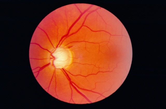 당뇨병 환자의 망막에 콜레스테롤이 쌓인다는 연구 결과가 나왔다./사진=클립아트코리아