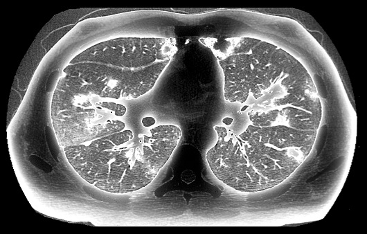 간유리음영 폐결절은 흉부 X-ray로는 잘 보이지 않아 흉부 CT 검사가 필요하다ㅣ출처: 클립아트코리아