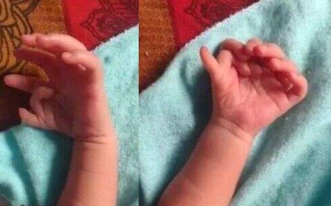 인도에서 손가락 14개, 발가락 12개인 여자 아기가 태어났다. / 영국 미